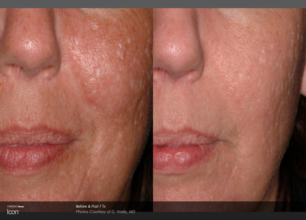 Scar-Removal-Before-and-After