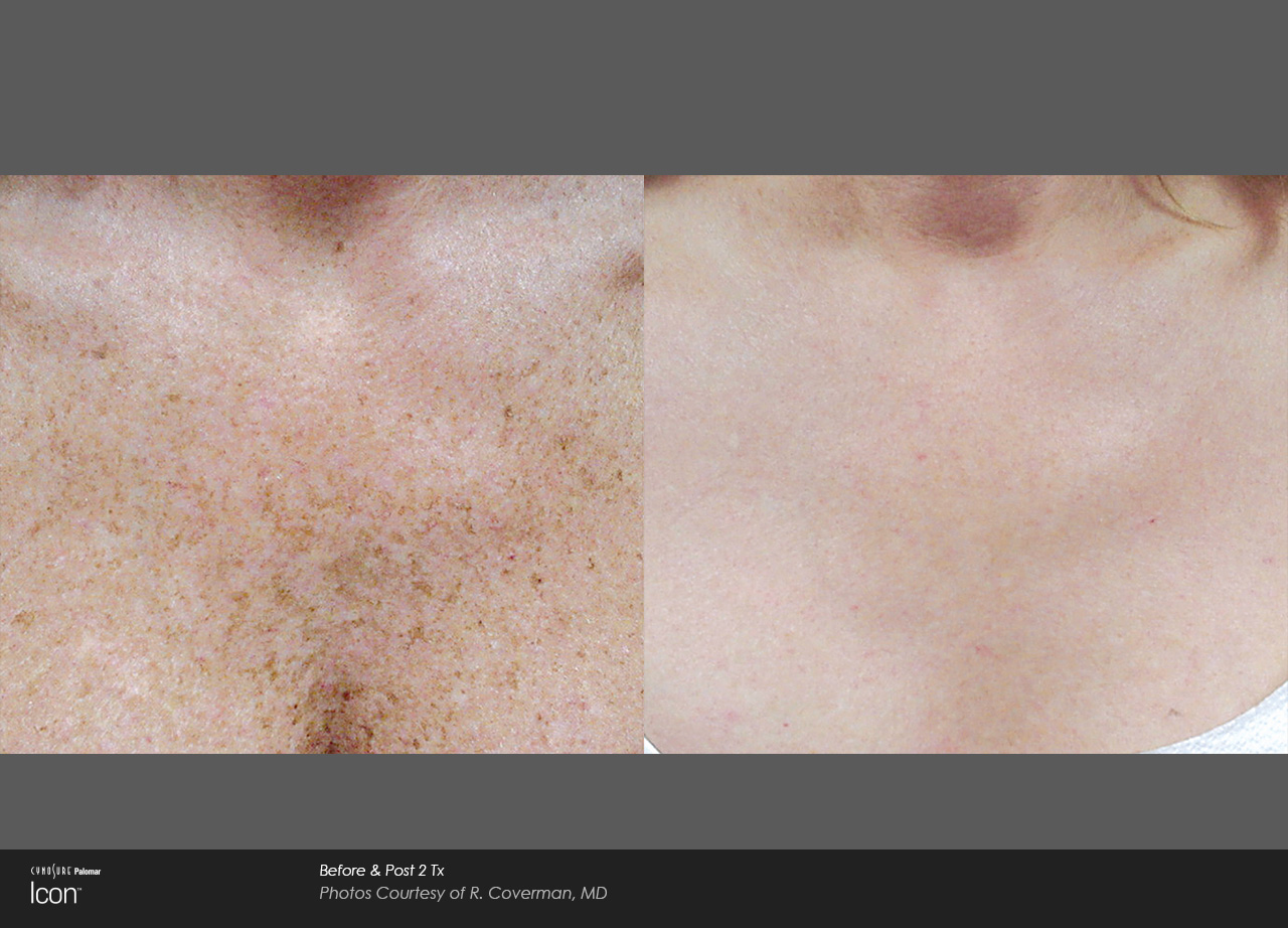 Skin-Revitalization-Before-&-After-Sun-Damage