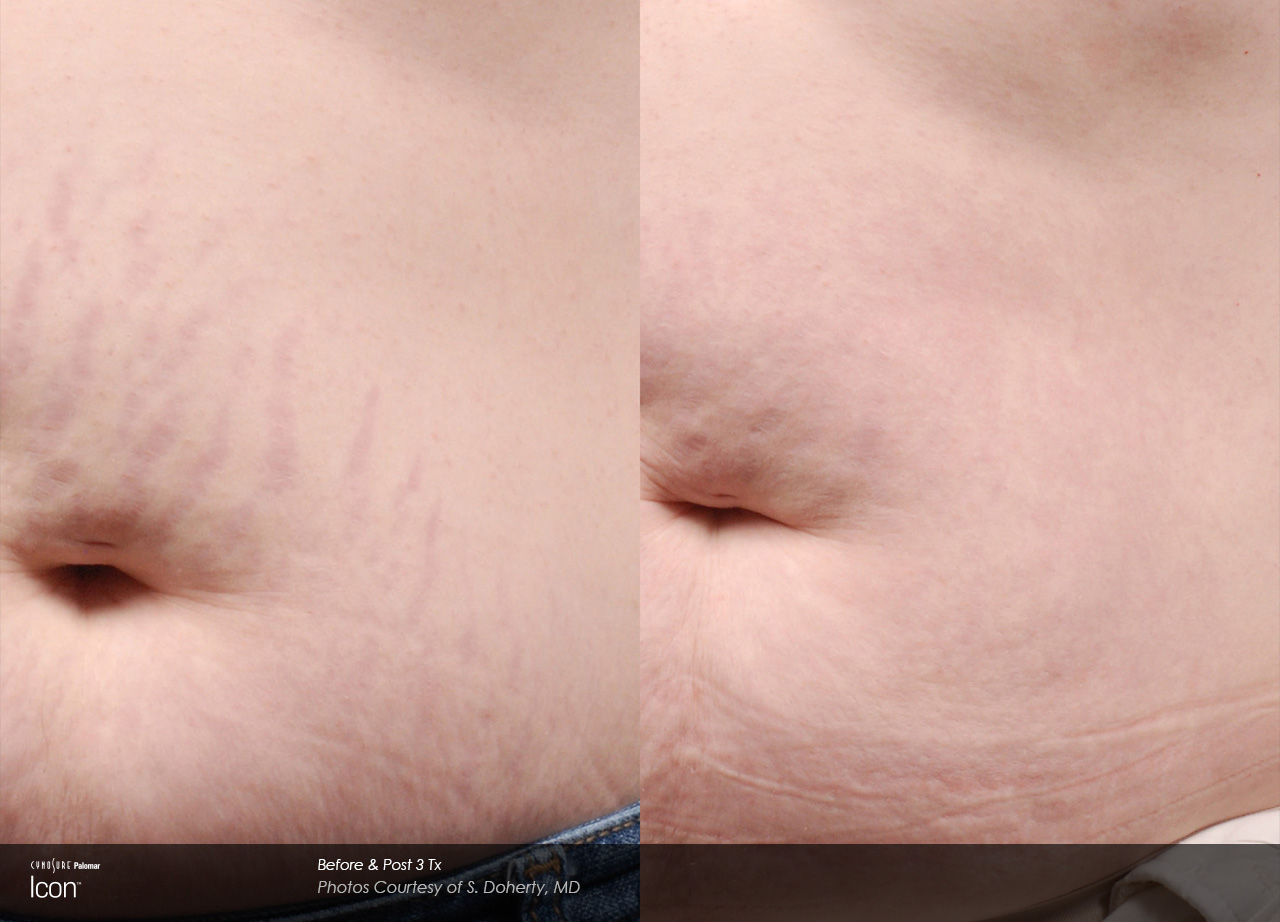 Stretch-Mark-Before-&-After