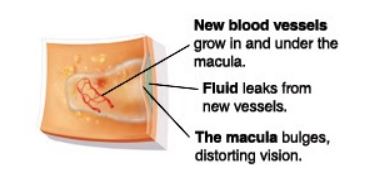 Wet Macular Degeneration