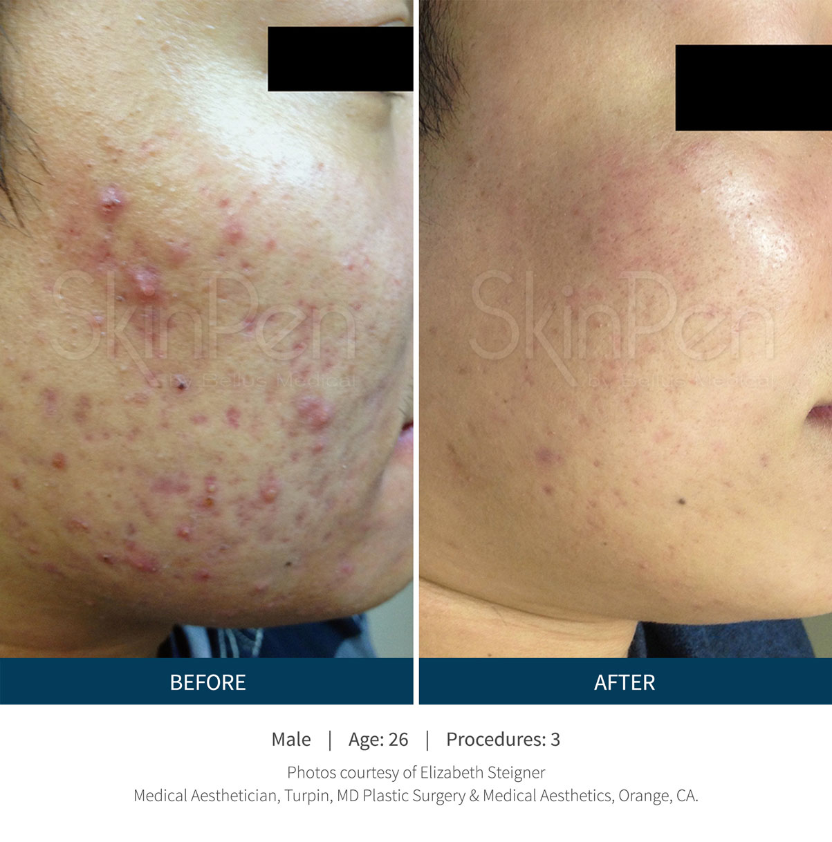 Before and After SkinPen to reduce acne damage and scarring