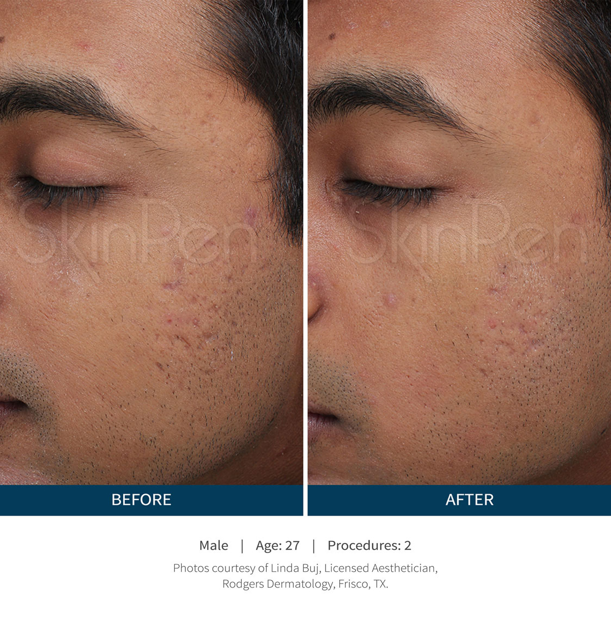 skinpen-male-before-after-1