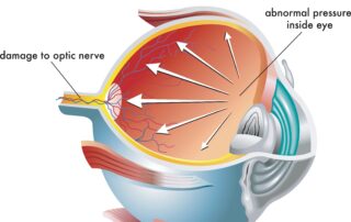 glaucoma progression