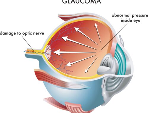 Glaucoma Progression: What Is It, What Are the Symptoms, and How Quickly Does It Progress?