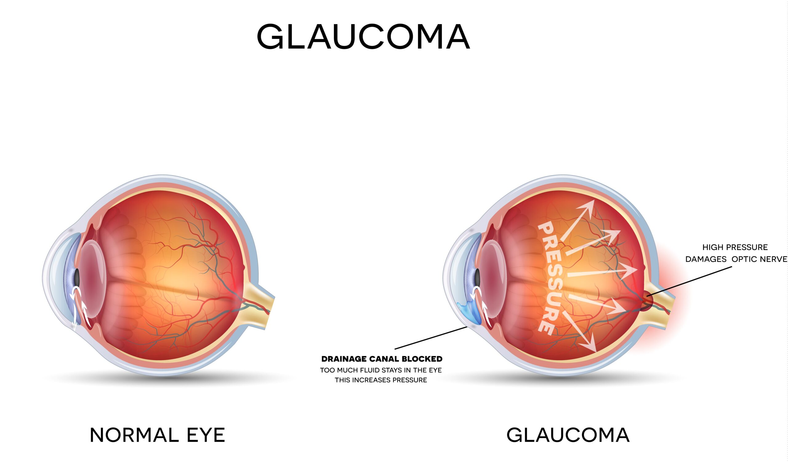 glaucoma symptoms