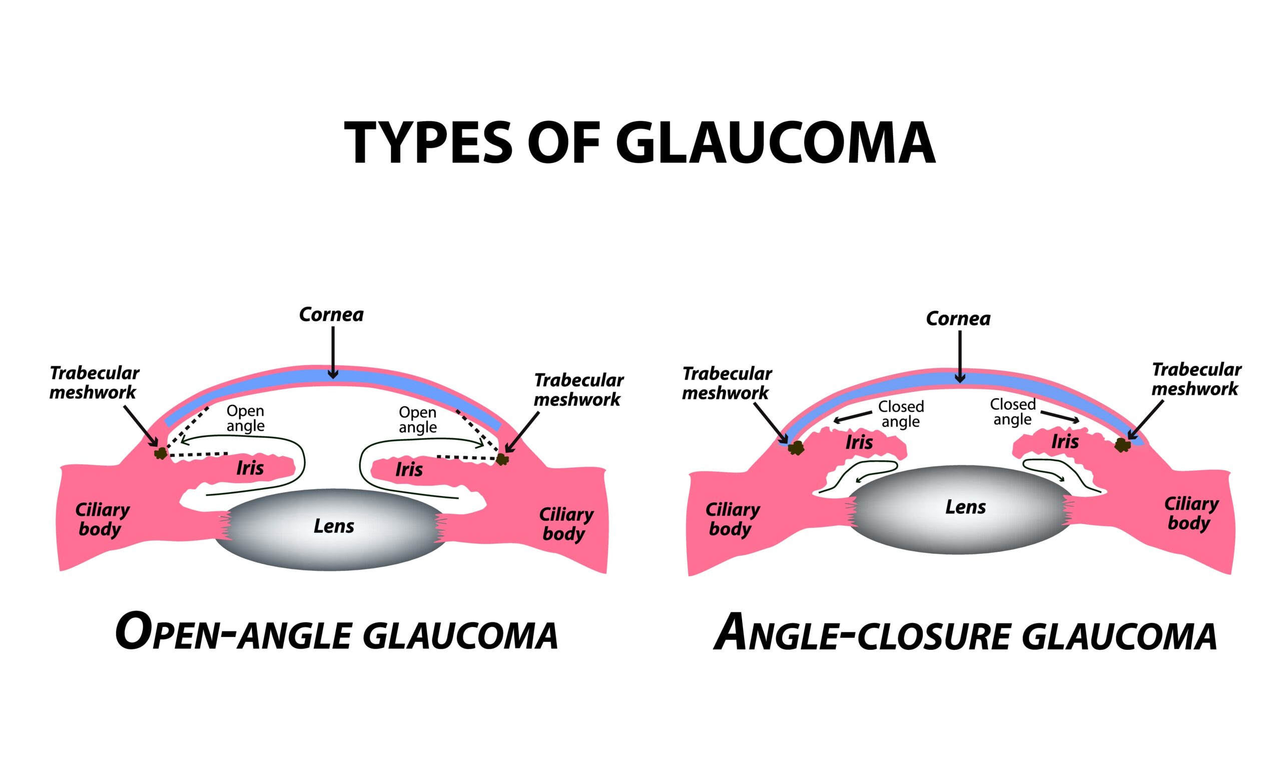 How Quickly Does Glaucoma Progress Eye Care Professionals