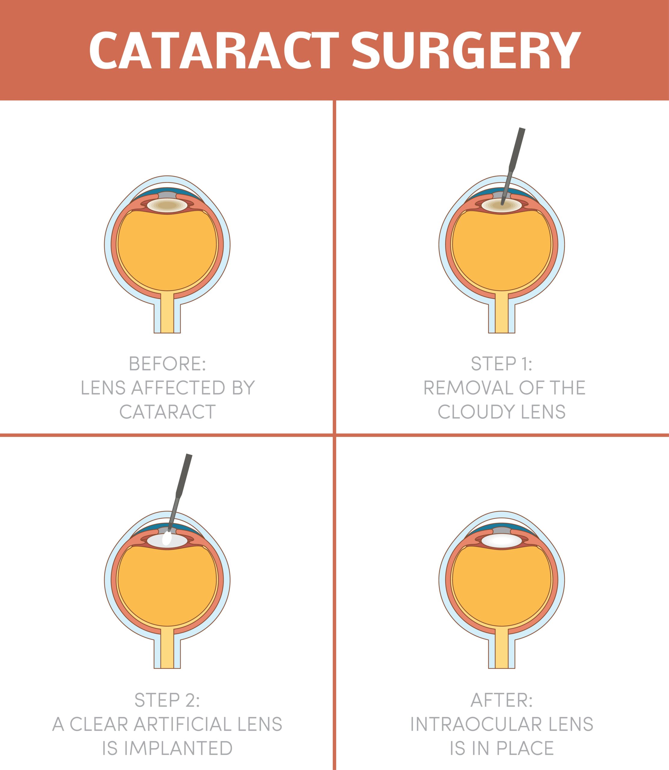 4 types of lenses