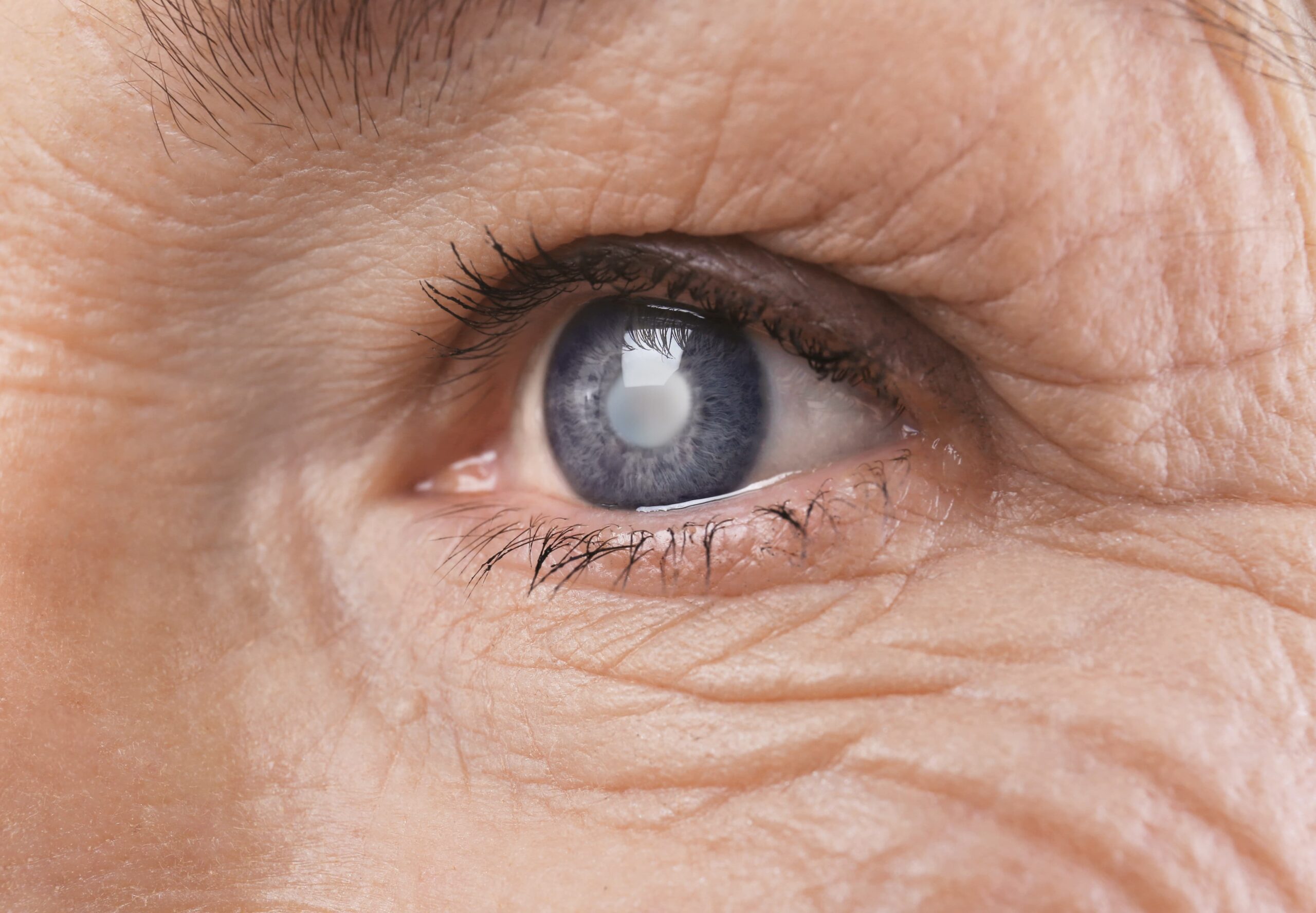LenSx Cataract Surgery in Reno for the removal of cataracts