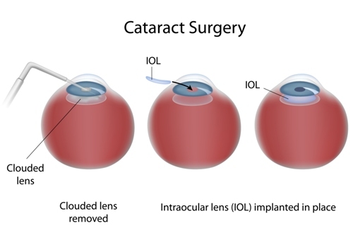 Intraocular lens procedure