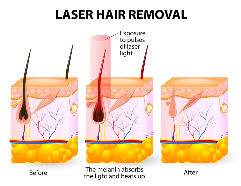 how laser hair removal works