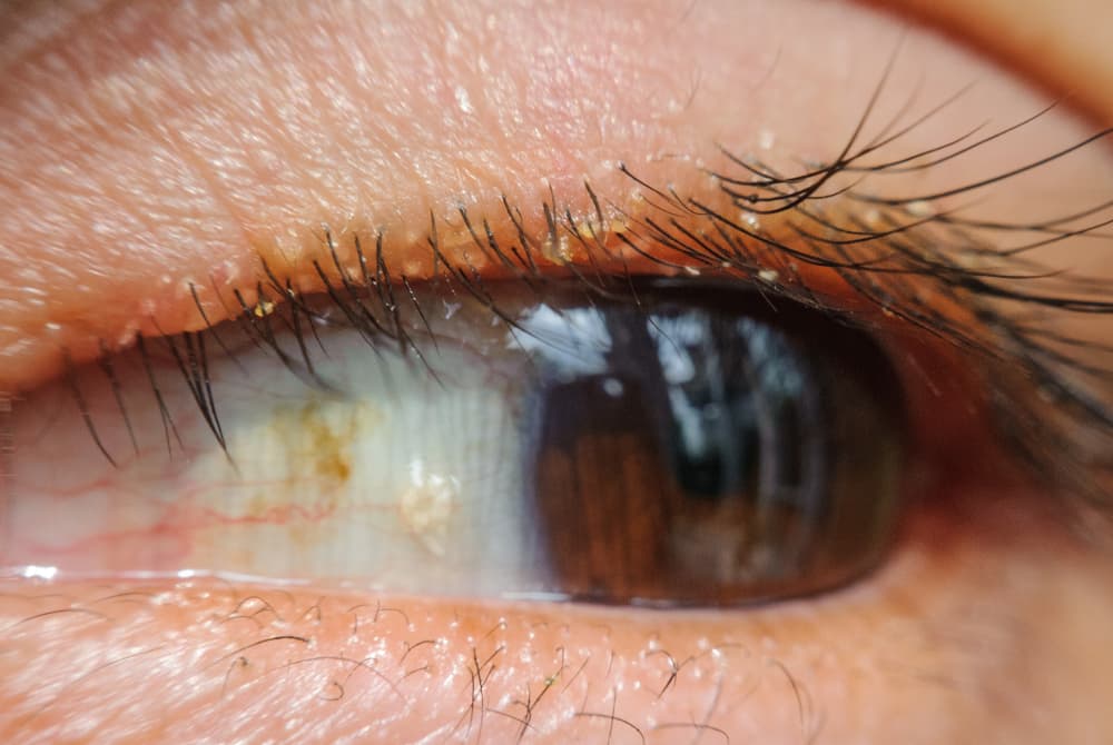 blepharitis-eye