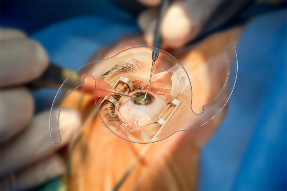 intraocular lens procedure