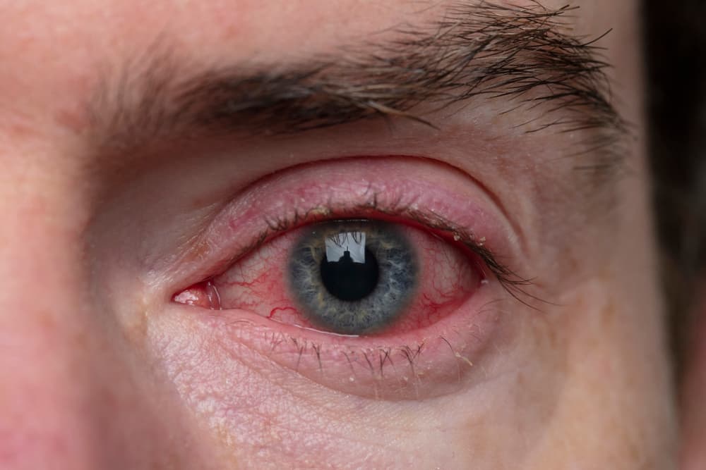 severe-bloodshot-eye-blepharitis