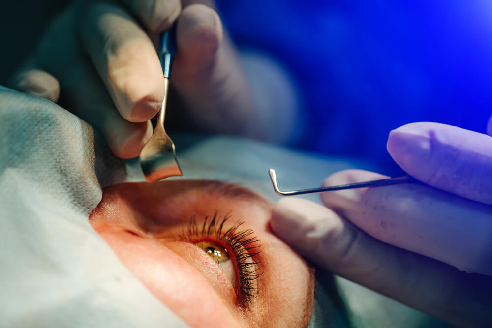 eye-cataract-surgery