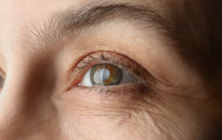 mature-women-with-cataracts