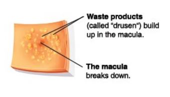 dry-macular-degeneration