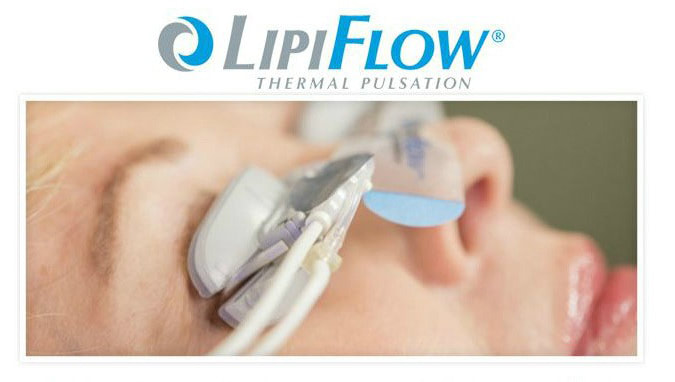Lipiflow Treatment for Blepharitis